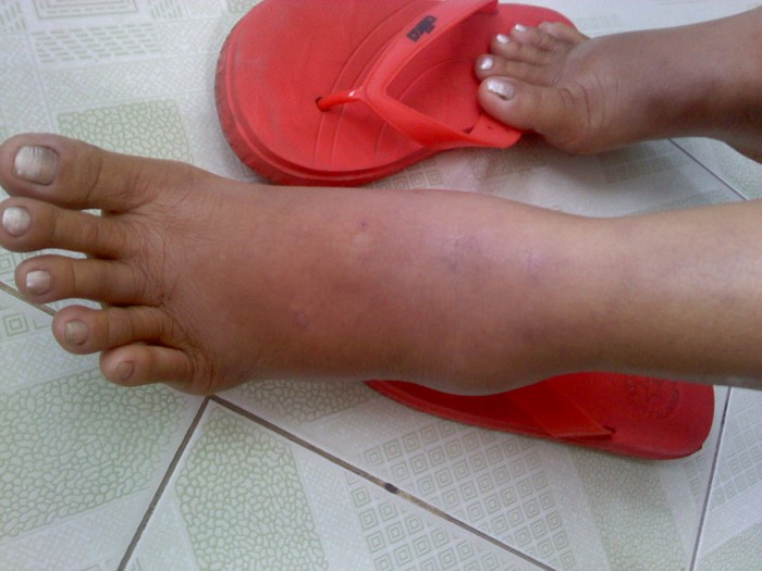 Một loại ký sinh trùng ẩn dưới da được điều trị tại Bệnh viện Bệnh nhiệt đới, TPHCM.